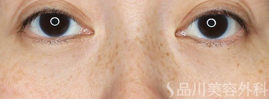 症例NO.71848のAFTER写真