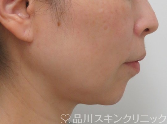 症例NO.71114のBEFORE写真