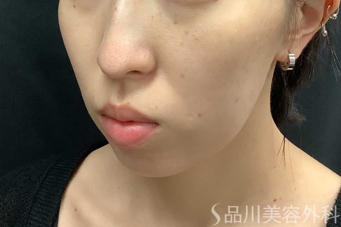 症例NO.69775のBEFORE写真