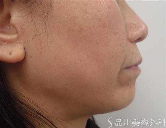 症例NO.10678のBEFORE写真