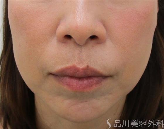 症例NO.43140のBEFORE写真