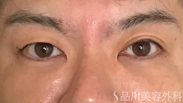 症例NO.65228のBEFORE写真
