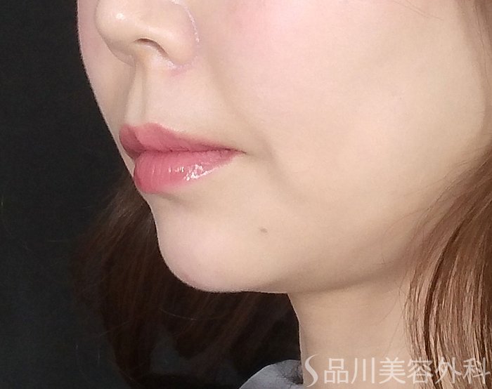 症例NO.69534のAFTER写真