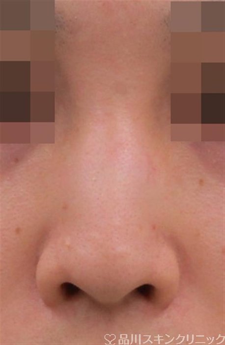 症例NO.39009のBEFORE写真