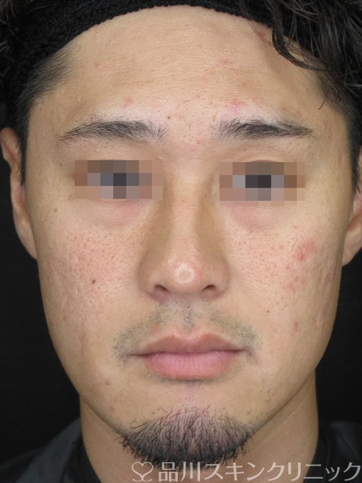 症例NO.67745のBEFORE写真