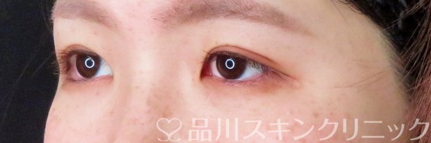 症例NO.74143のAFTER写真