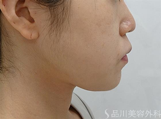 症例NO.51373のBEFORE写真