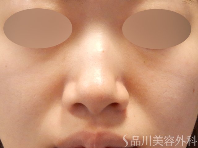 症例NO.71809のBEFORE写真