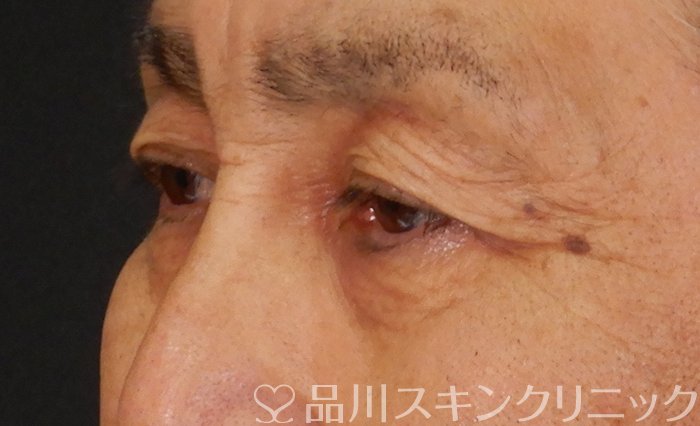 症例NO.66780のBEFORE写真