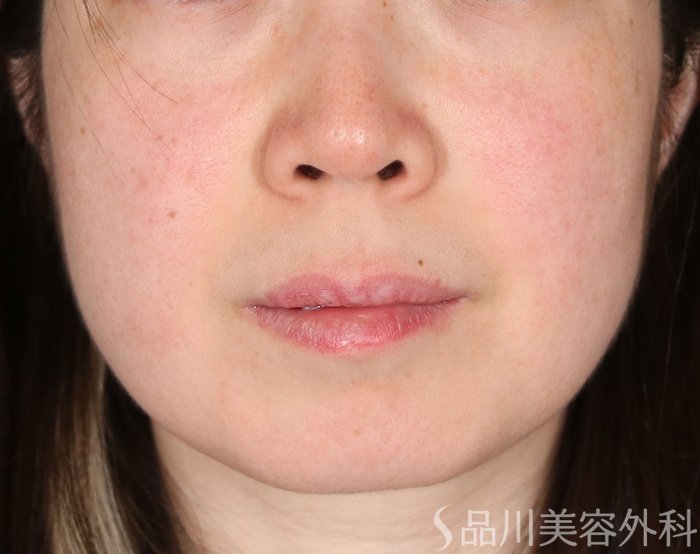 症例NO.72782のBEFORE写真