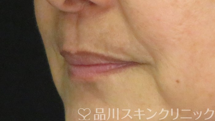 症例NO.70041のBEFORE写真