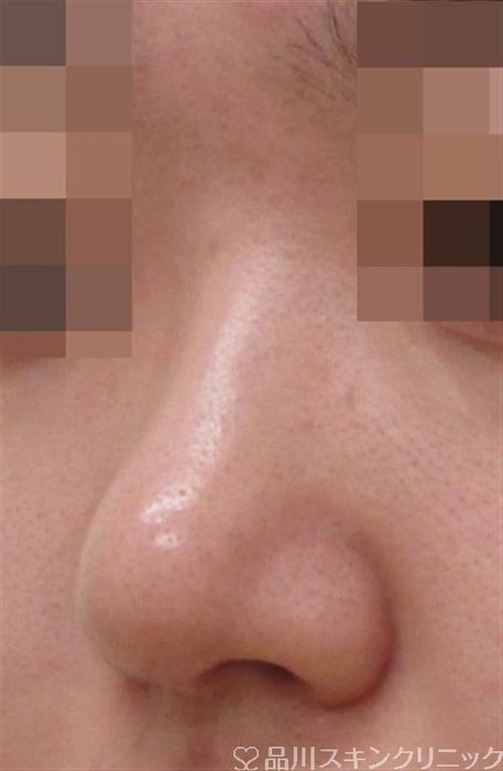 症例NO.38643のAFTER写真