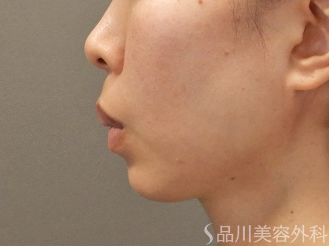 症例NO.73904のBEFORE写真