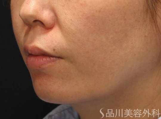 症例NO.74351のBEFORE写真
