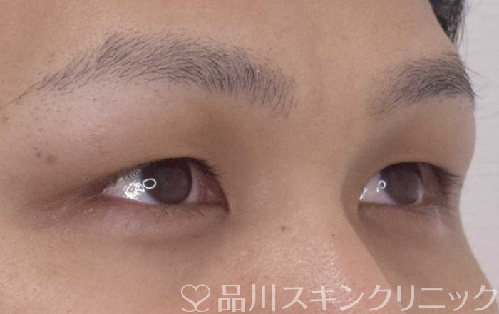 症例NO.62092のBEFORE写真