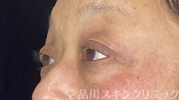 症例NO.71421のBEFORE写真