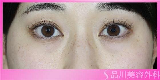 症例NO.54779のBEFORE写真