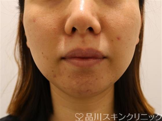 症例NO.41244のBEFORE写真