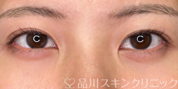 症例NO.65513のBEFORE写真