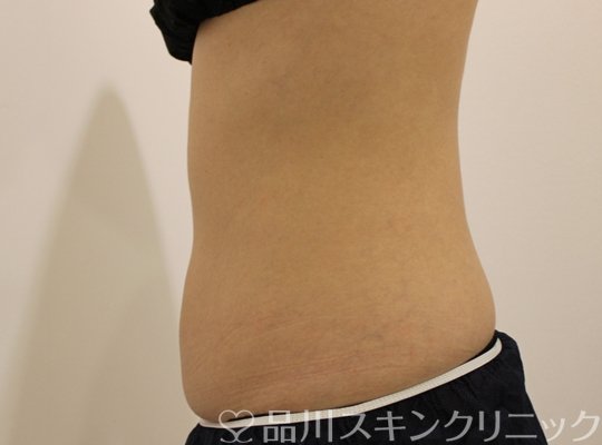 症例NO.73004のAFTER写真