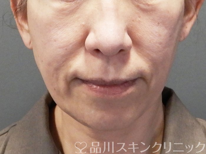 症例NO.73575のBEFORE写真