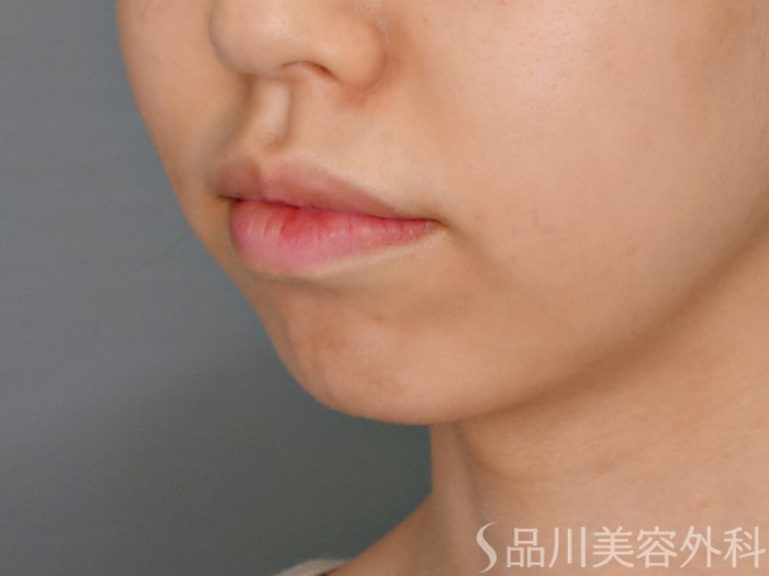症例NO.70454のBEFORE写真
