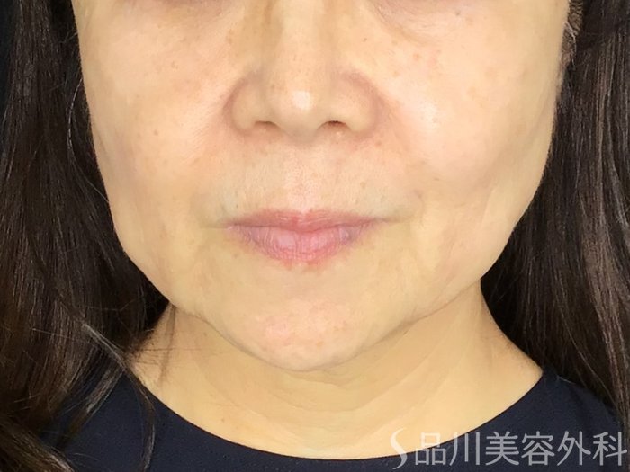 症例NO.67581のBEFORE写真
