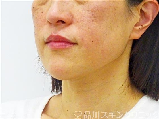 症例NO.44530のAFTER写真