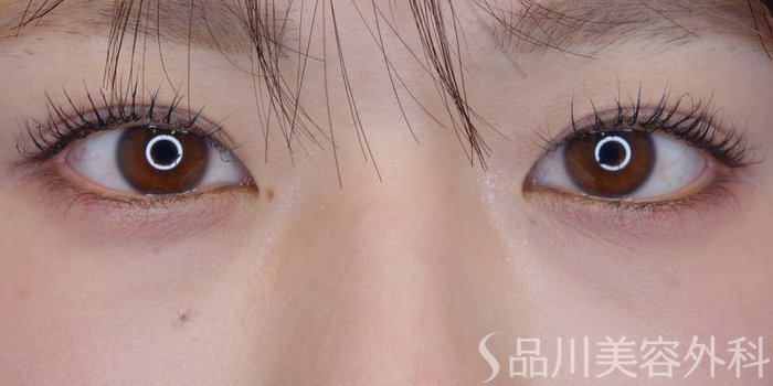 症例NO.72070のBEFORE写真