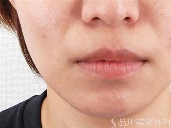 症例NO.61254のAFTER写真