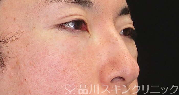 症例NO.74583のAFTER写真