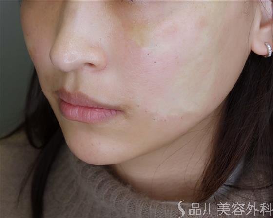 症例NO.49504のAFTER写真