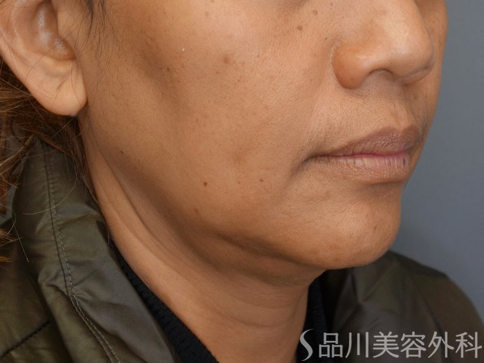 症例NO.72276のBEFORE写真