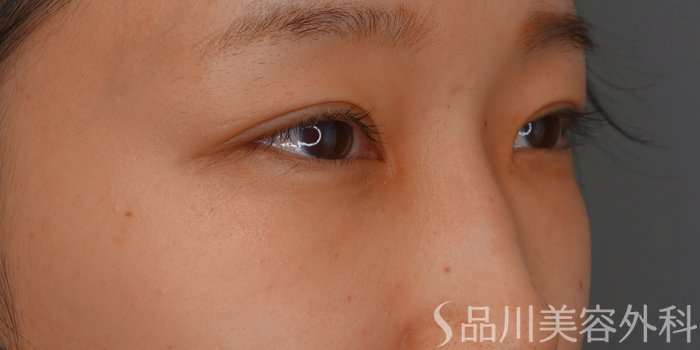症例NO.74470のAFTER写真