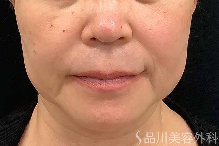 症例NO.73321のBEFORE写真