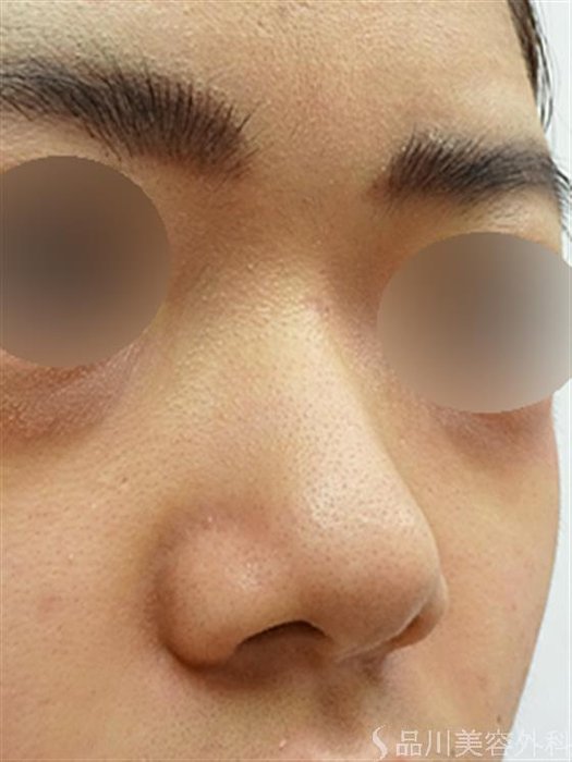 症例NO.42650のBEFORE写真