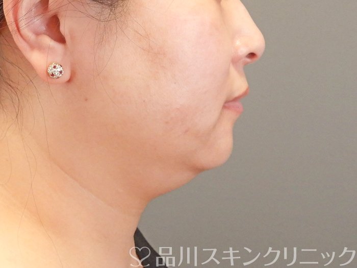 症例NO.63669のBEFORE写真
