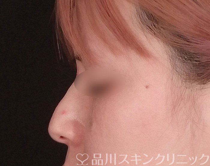 症例NO.69801のAFTER写真