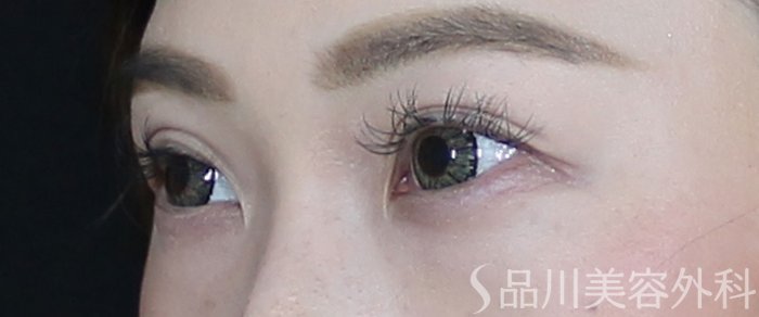 症例NO.73033のAFTER写真