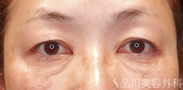 症例NO.74645のBEFORE写真
