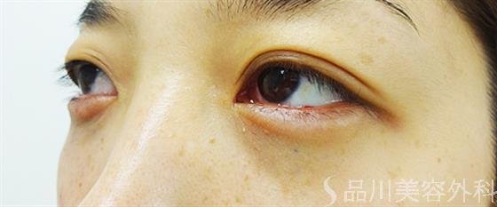 症例NO.25302のAFTER写真