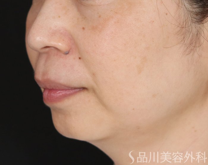 症例NO.71207のBEFORE写真