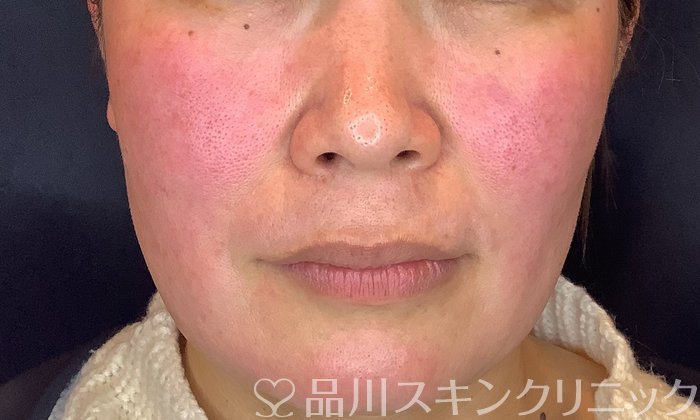症例NO.74967のBEFORE写真