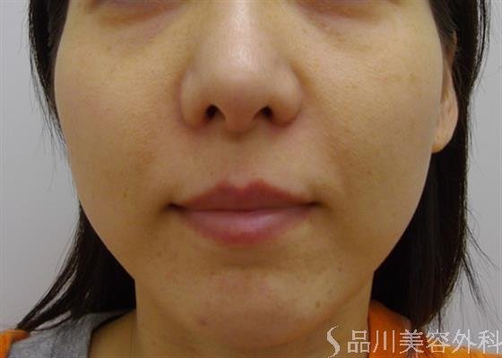 症例NO.27831のBEFORE写真