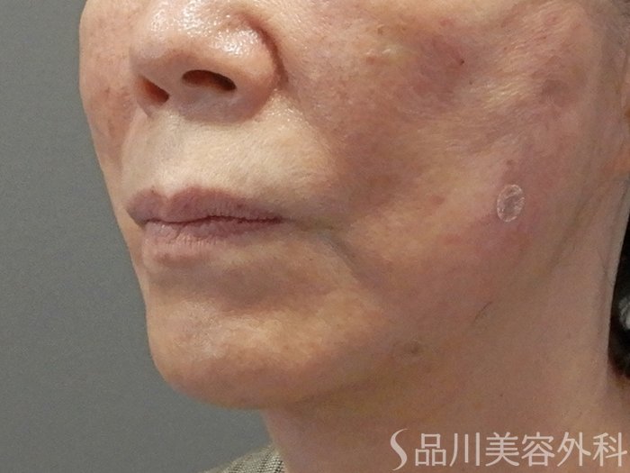症例NO.71712のAFTER写真