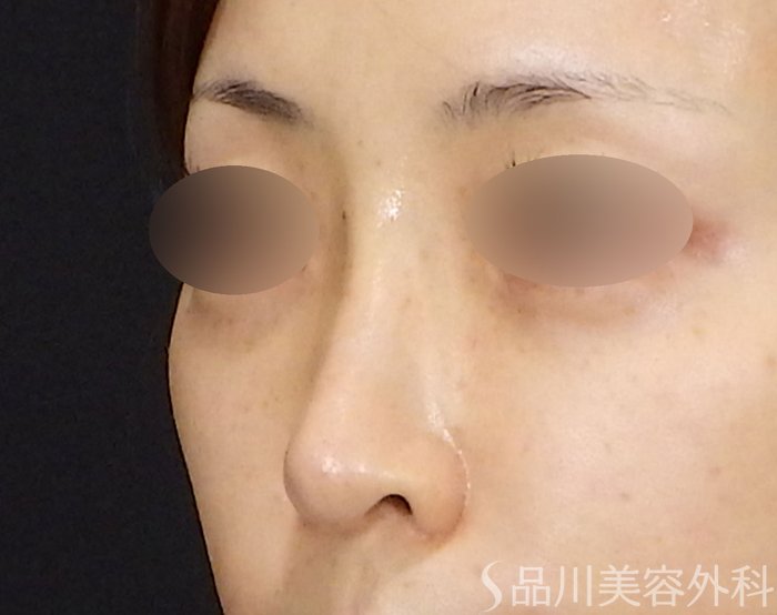 症例NO.71471のBEFORE写真