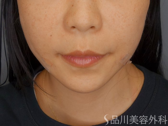 症例NO.72758のAFTER写真