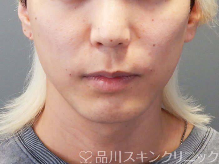 症例NO.74370のAFTER写真