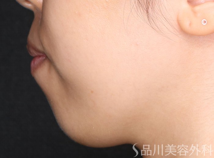 症例NO.72313のBEFORE写真