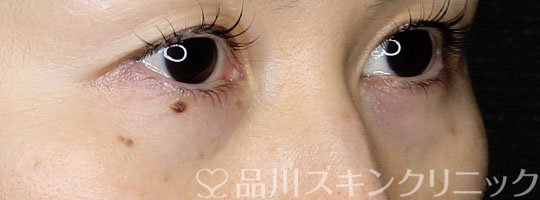 症例NO.71130のBEFORE写真